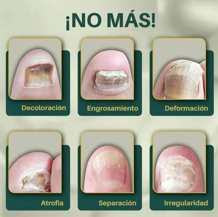 SUERO ANTI HONGOS 7 DIAS NAIL1